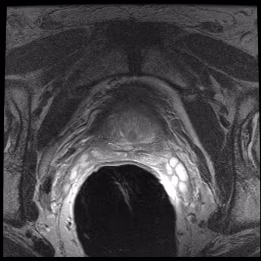 Axial T2 slice 12 of the prostate series