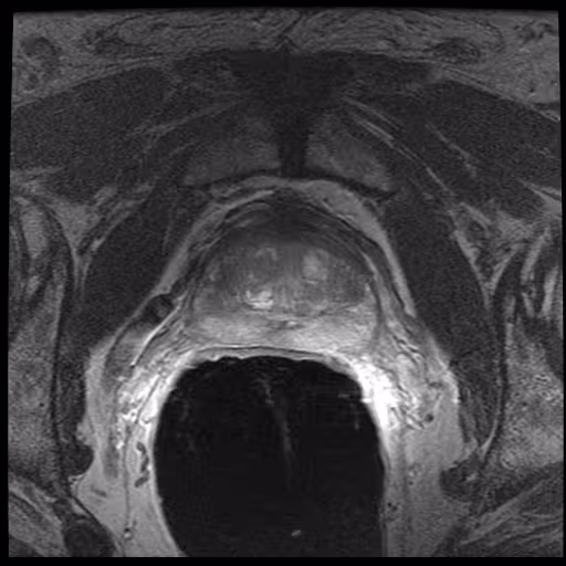 Axial T2 magnetic-resonance slice through a prostate