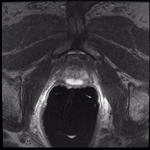 Axial T2 slice 20 of the prostate series