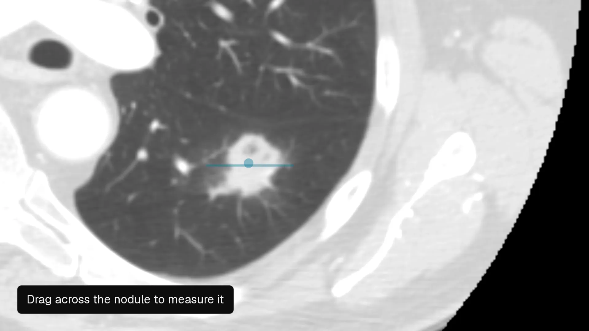 The Nitsor editor on a chest CT: the Nodule centre point category is selected in the label rail, a cyan point is placed on a nodule, and a line dragged across the nodule gives a length that the editor shows as a temporary measurement, not recorded.