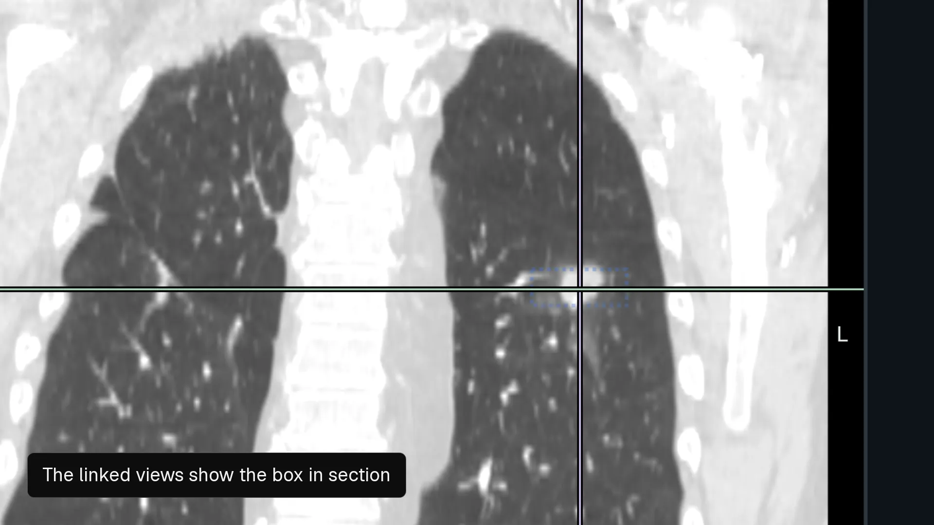 A close-up of a lung nodule on a chest CT slice in the Nitsor editor: a blue dotted box is drawn around it and holds it from slice 73 to 79, the linked coronal and sagittal views show the box in section, and the rail lists the box as a label spanning slices 73 to 79.
