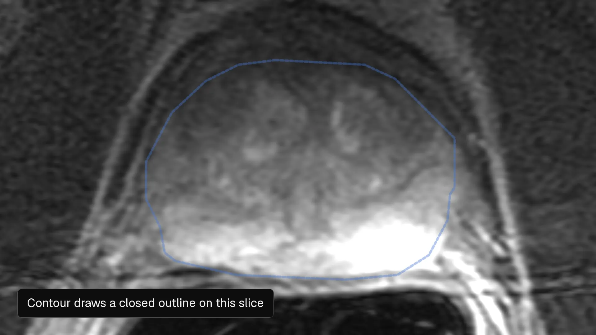A close-up of an axial T2-weighted prostate MRI in the Nitsor editor: slices are stepped through, then a blue outline is drawn around the prostate with the Contour tool and appears as a label in the rail.