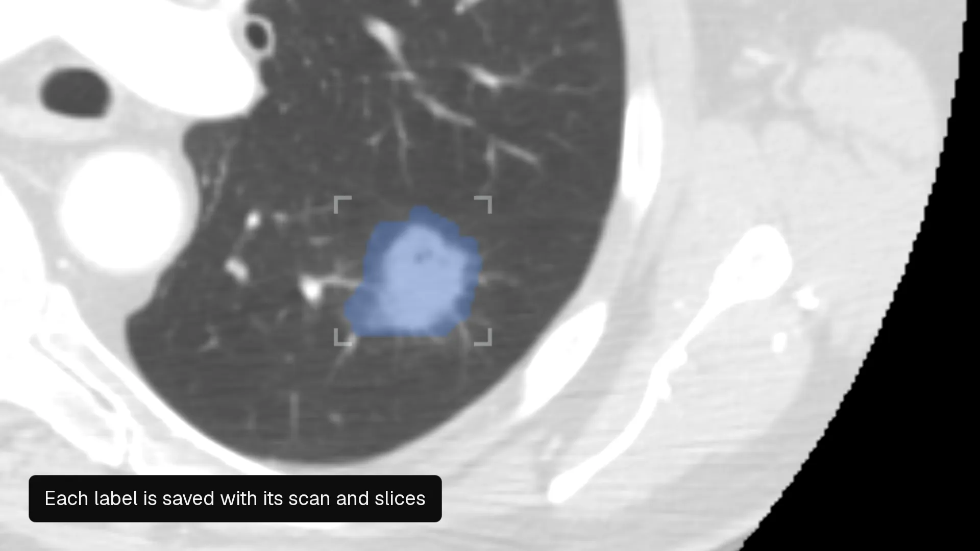The Nitsor editor steps through slices of a chest CT; a blue nodule label is selected and framed on the scan.