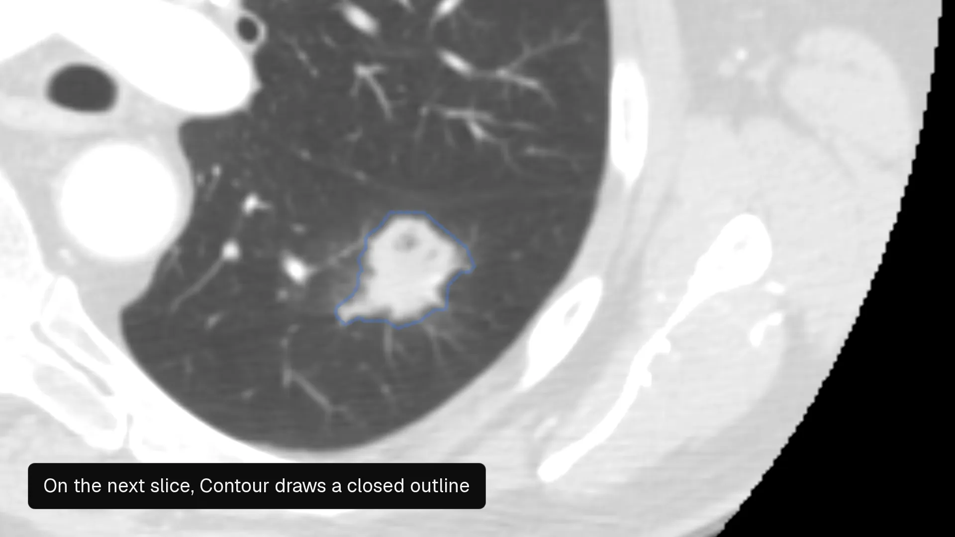 A close-up of a lung nodule on a chest CT slice in the Nitsor editor: a blue Brush mask fills the nodule, then on the next slice a blue Contour outline closes around it, and both drawings appear as labels in the rail.