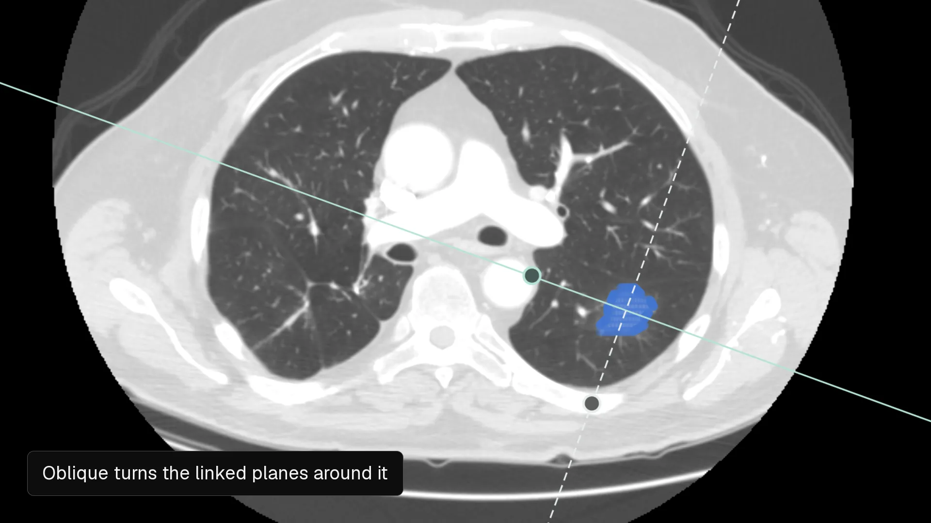 The Nitsor editor on a chest CT: the axial slice counts up while a position line moves up the coronal plane, the linked position meets a blue nodule label, Oblique then turns the two linked planes 20 degrees about it, and the coronal plane cuts the nodule at an angle.