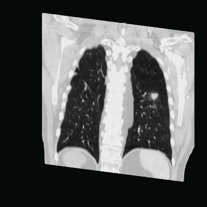 The chest CT rebuilt as one volume and opened by a coronal plane through the nodule: both lungs, the spine and the ribs in cross-section, with the nodule a small bright spot in the left lung.
