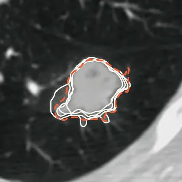 A lung nodule on a chest CT slice, outlined four times in white by four radiologists and once, dashed, by a model.