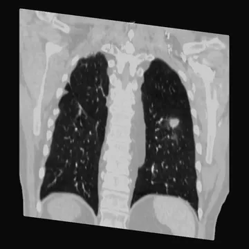 The chest CT rebuilt as one volume and opened on a coronal plane through both lungs.