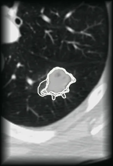 A lung nodule in a chest CT slice, outlined four times in white by four radiologists whose outlines differ at the edges.