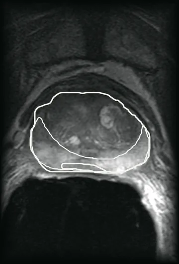 A prostate MRI slice with the gland, its peripheral zone and a small lesion outlined in white as the annotators drew them.