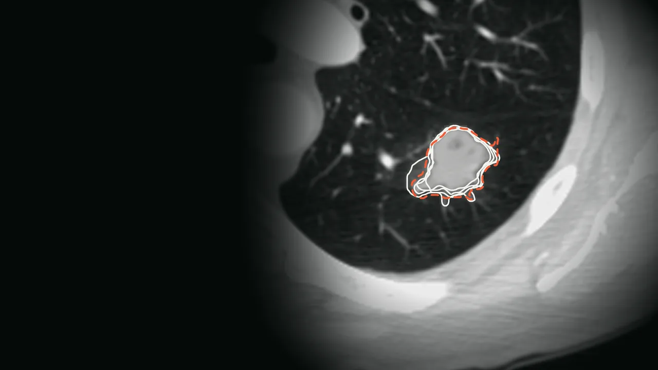 A lung nodule on a chest CT slice, outlined in white by four radiologists and once, dashed in orange, by a model.