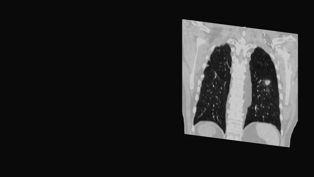 The chest CT rebuilt as one volume and opened on a coronal plane through both lungs.