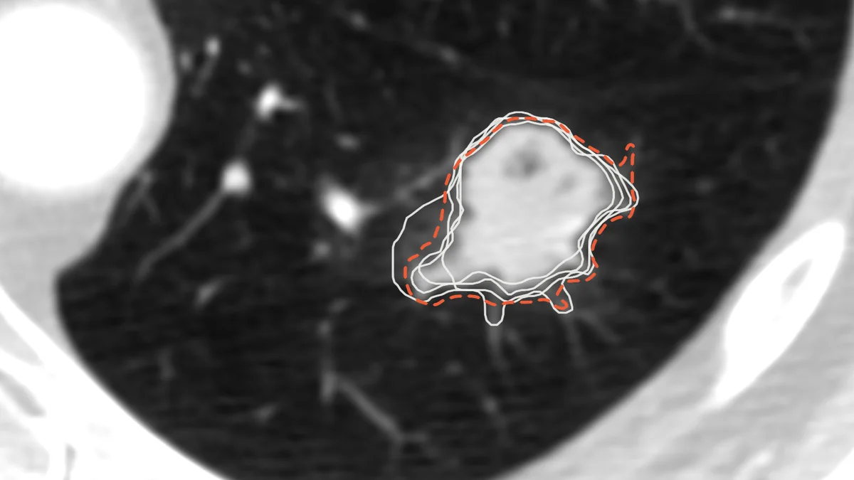 A lung nodule on a real chest CT slice, outlined by four radiologists in white and by SAM 2.1's dashed proposal.