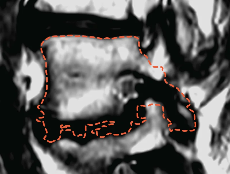 A sagittal spine MRI slice with a dashed model outline that spills past one vertebra into the disc and the vertebra below.