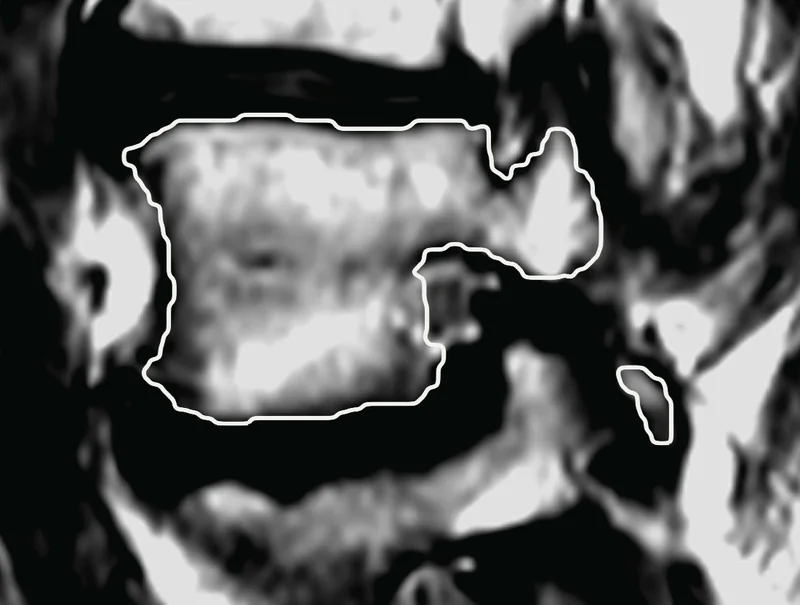 The same slice with the published outline of the vertebra in white, tighter than the model's.