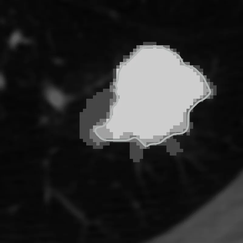 The same nodule shaded by how many readers covered each pixel, lighter where more agree, with a thin grey outline where at least three agree.