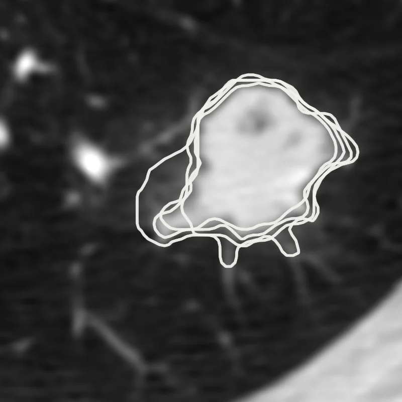 Four white outlines of one lung nodule, drawn by four radiologists, overlapping but not identical.