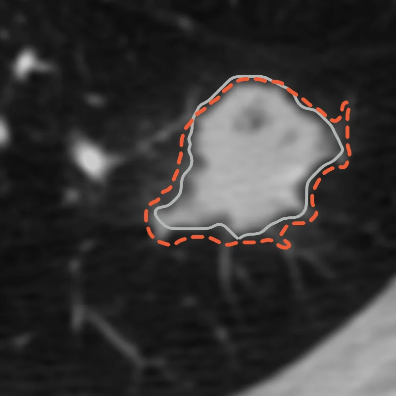 A dashed model outline around the nodule against the thin grey outline where at least three readers agree.