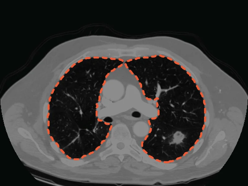 A chest CT slice with the lungs outlined as two classes, left and right.