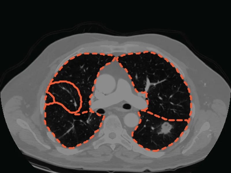 The same slice with the lungs outlined as five lobes.
