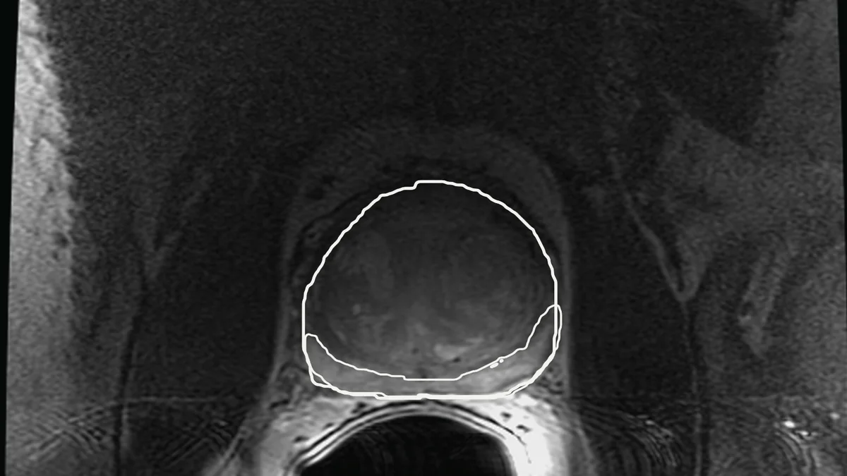 An axial T2-weighted MRI slice of a prostate, with the published manual outlines of the prostate and its peripheral zone in white.