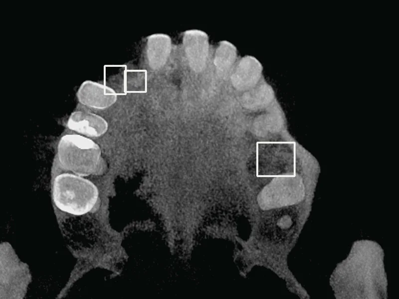 The upper teeth of a real dental cone-beam CT seen from above; white boxes mark the gaps where teeth are missing, labelled maxillary anterior and maxillary posterior.