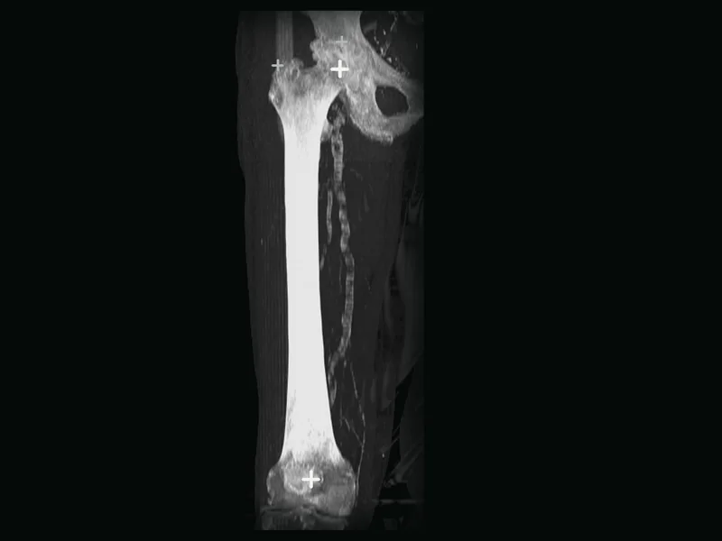 A real femur CT shown as a projection, with white crosses at the centre of the femoral head and the centre of the knee.