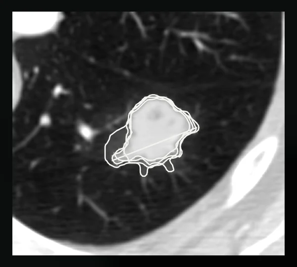 A chest CT nodule with four radiologists' published outlines in white, grey levels for how many include each pixel, and a longest-diameter line derived from the outlines.