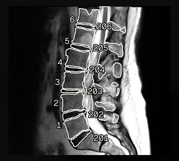 A sagittal lumbar spine MRI slice with the published vertebra and disc masks outlined in white, the vertebrae numbered 1 to 6 and the discs 201 to 206.