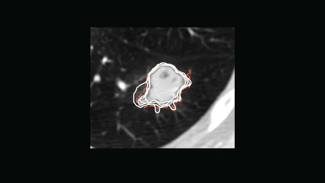 The nodule with four radiologists' outlines in white beside the model's dashed proposal.