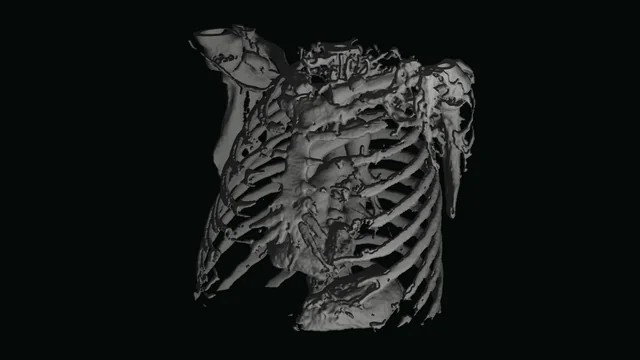 A chest's ribs and spine rendered from a clinical CT scan.
