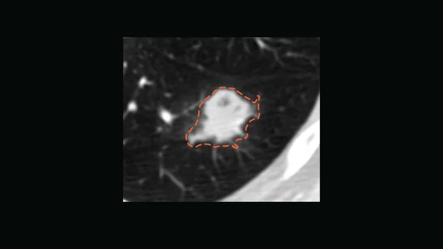 The nodule with the model's proposal drawn as a dashed outline.