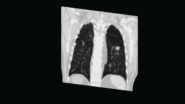 A coronal plane cuts the chest open, showing both lungs and a small nodule in the left lung.