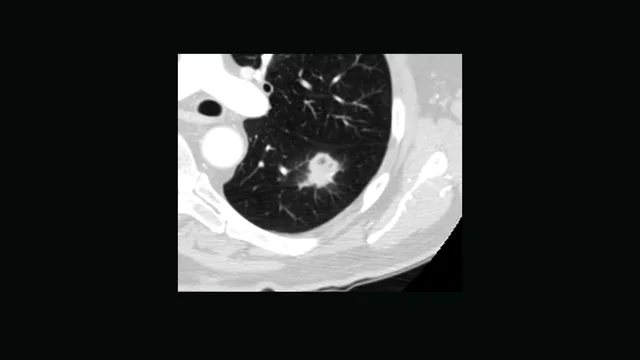 One axial CT slice through the lungs with a small nodule.