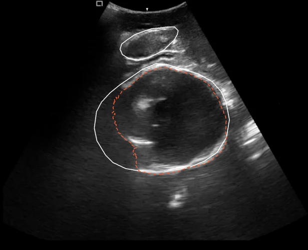 Frames from an intrapartum transperineal ultrasound video: the pubic symphysis near the top and the round fetal head below it, each outlined in solid white from the published masks, and a dashed SAM 2.1 proposal following the head from frame to frame, close to the white outline except along its faint left edge. Against the published head mask, the proposal scores Dice 0.85 to 0.95 across the 24 frames.