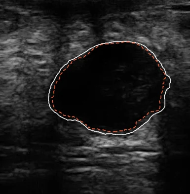 A real 2D breast ultrasound image of a dark, oval lesion. The lesion outline the ultrasonographer drew is solid white; a box fitted to the published outline prompts SAM 2.1, whose proposal is a dashed line just inside the white outline. Measured on this image only, the proposal scores Dice 0.94 against the white outline.