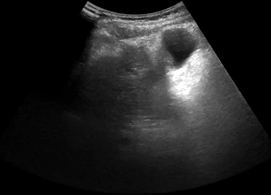 A liver ultrasound image from a curved probe, cropped. No label is drawn.